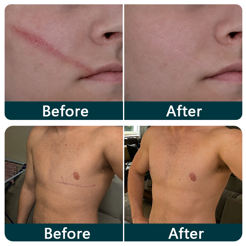 TRILUMIA silicone scar roll