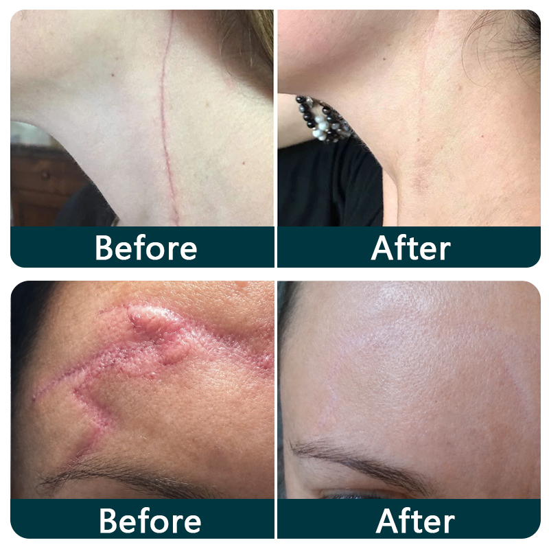 TRILUMIA silicone scar roll