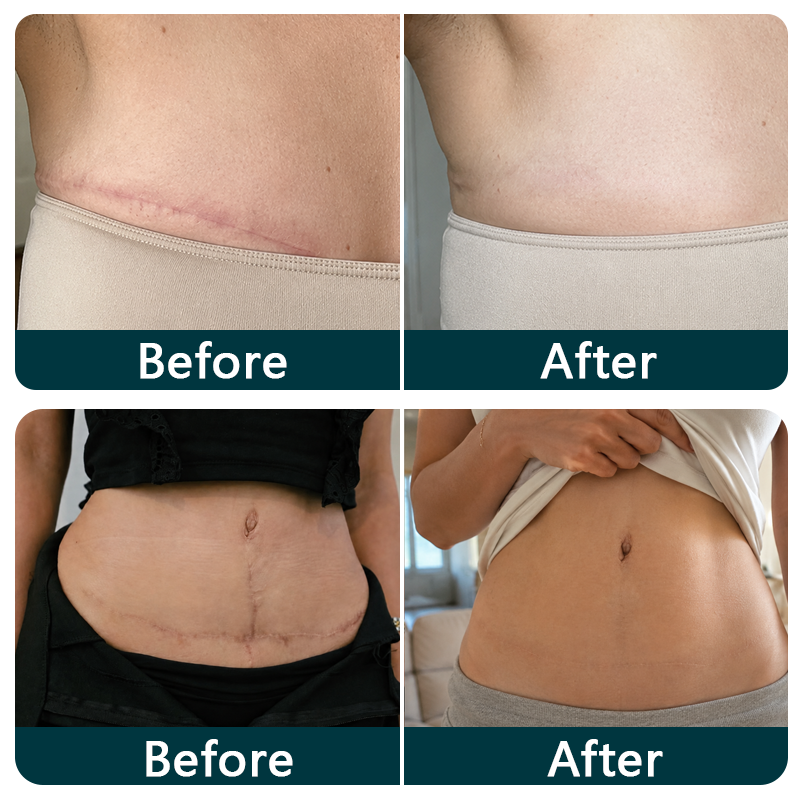 TRILUMIA silicone scar roll